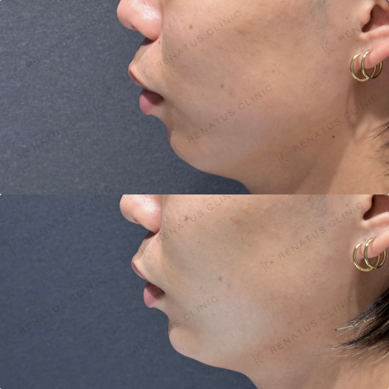 顎ヒアルロン酸ボラックス症例写真