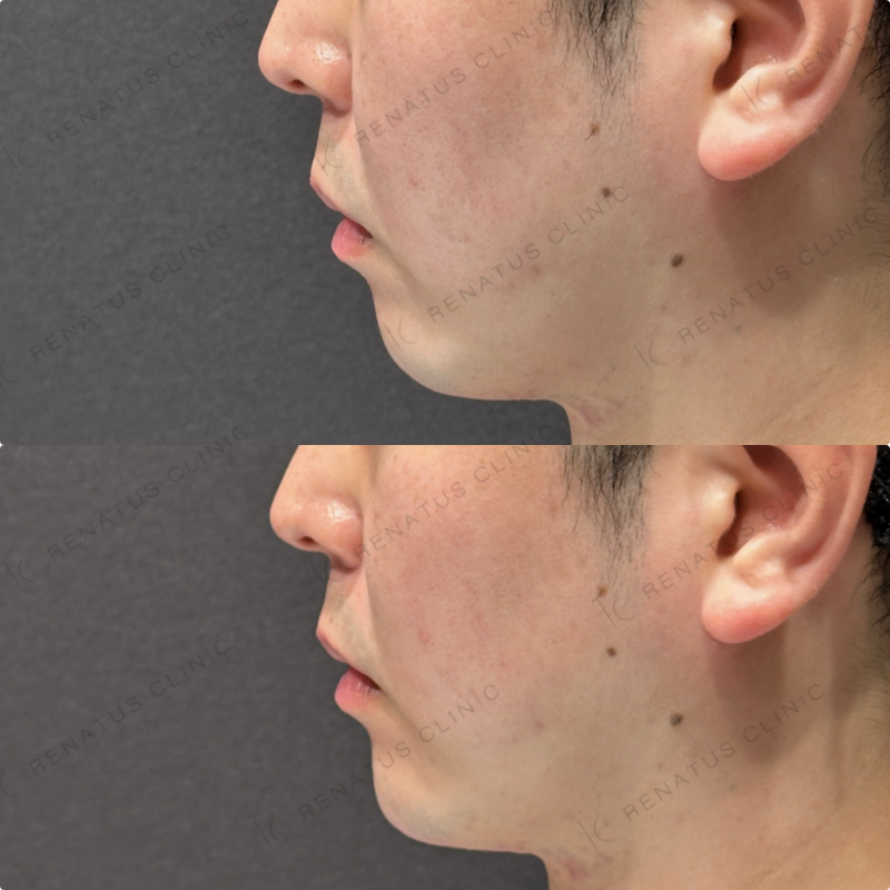 顎ヒアルロン酸ボラックス症例写真