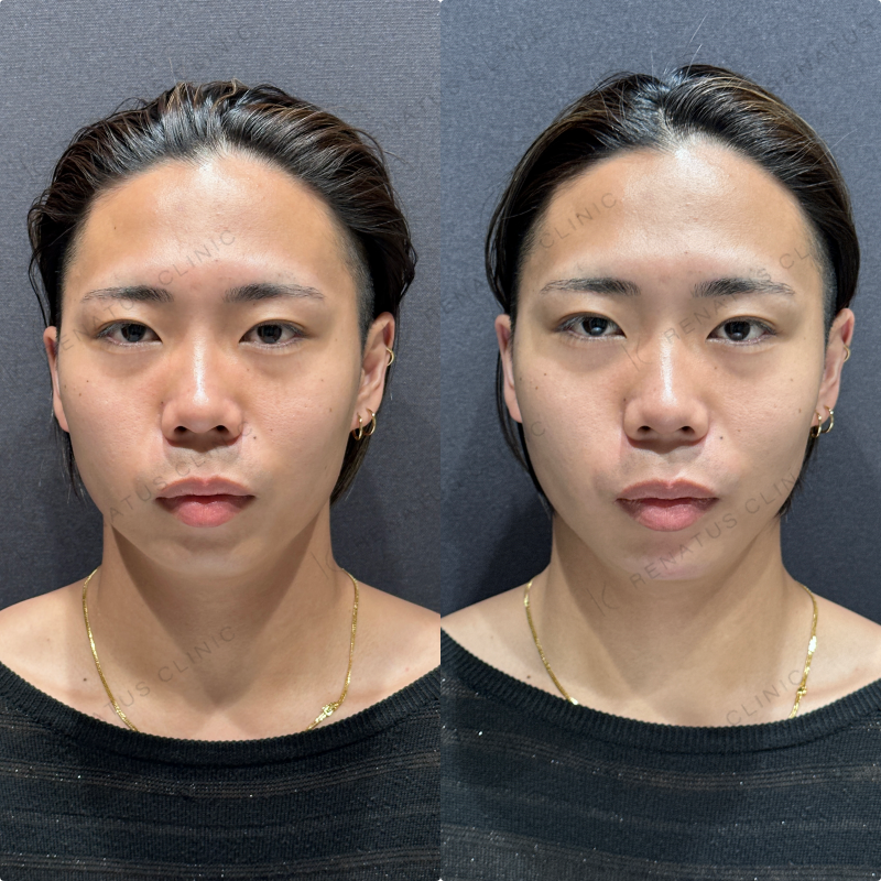 顎ヒアルロン酸ボラックス症例写真