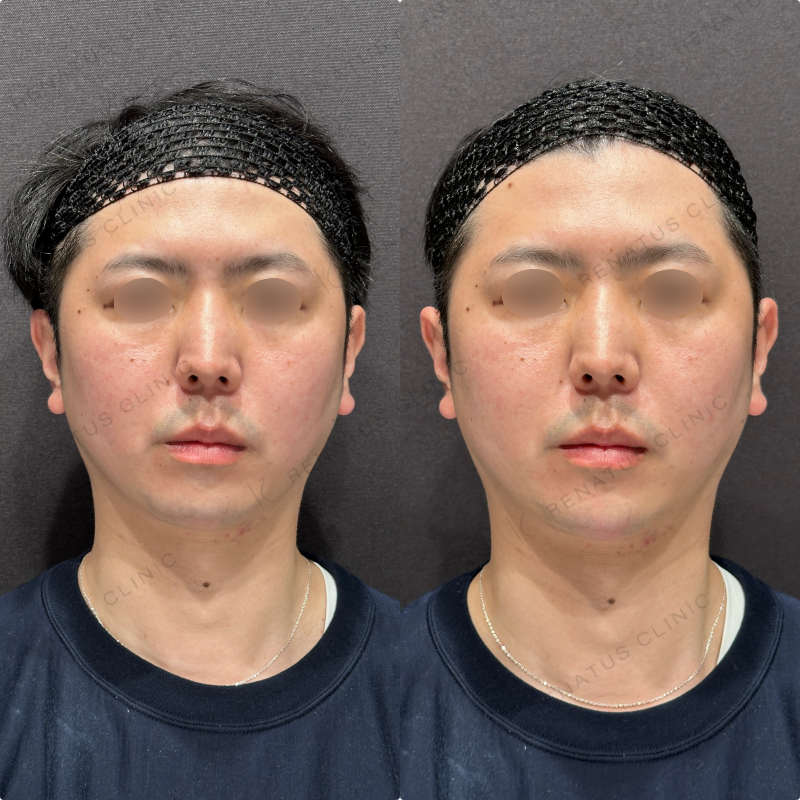 顎ヒアルロン酸ボラックス症例写真