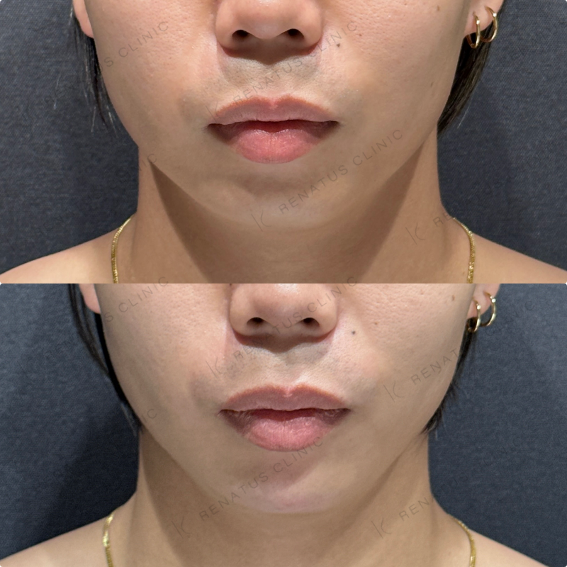 顎ヒアルロン酸ボラックス症例写真