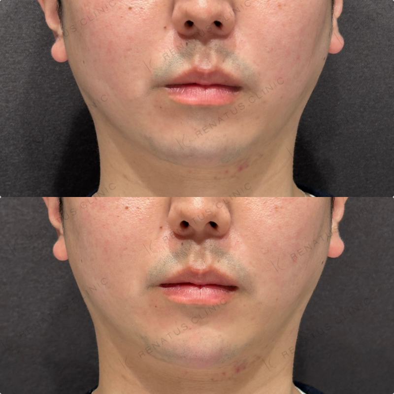 顎ヒアルロン酸ボラックス症例写真