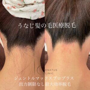 仙台でうなじ脱毛ならうなじ矯正専門店より医療脱毛のレナトゥスクリニック - 医療脱毛症例写真