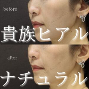 東京で貴族フィラーが上手い先生