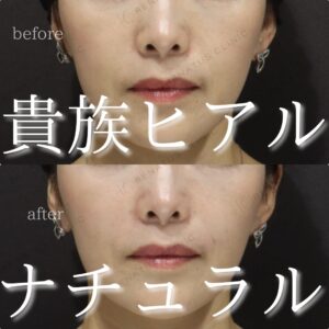 東京で貴族フィラーが上手い先生