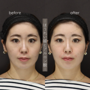 ほうれい線ヒアルロン酸が安い。新宿レナトゥスクリニックの自然な仕上がり技術の症例写真