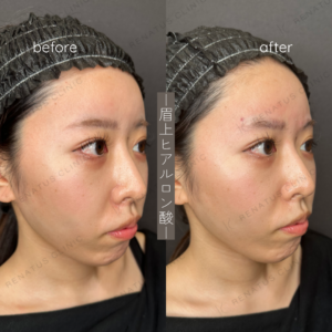 眉弓ヒアルロン酸：女性らしさを損なわない自然な立体感をヒアルロン酸で演出の症例写真