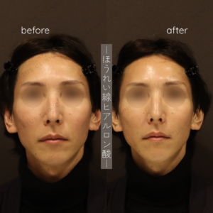 ほうれい線ヒアルロン酸ボリフト症例写真の症例写真