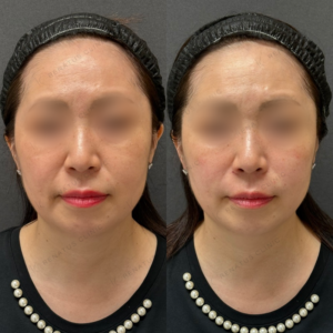 頬コケヒアルロン酸症例写真の症例写真