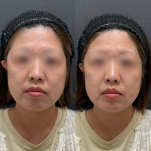 顎ヒアルロン酸症例写真の症例写真