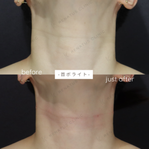 ボライト首症例写真の症例写真