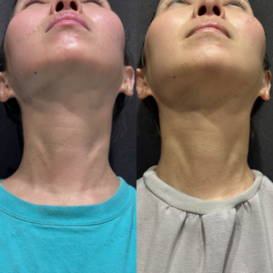 首ヒアルロン酸ボライト症例写真の症例写真