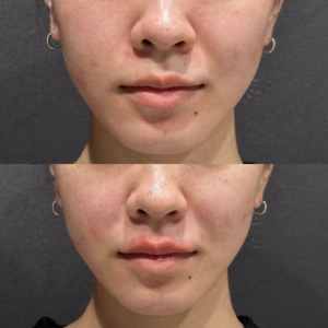 ほうれい線ヒアルロン酸ダイヤモンドフィール症例写真の症例写真