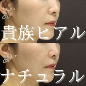 東京で貴族フィラーが上手い先生