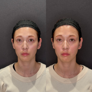 ほうれい線ヒアルロン酸ピネハ症例写真｜レナトゥスクリニック　名古屋で一番上手いヒアルロン治療の症例写真