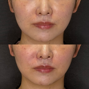 ほうれい線ヒアルロン酸症例写真｜レナトゥスクリニックの症例写真