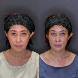 頬ボライト症例写真｜レナトゥスクリニック　名古屋名駅おすすめのフィラー治療の症例写真