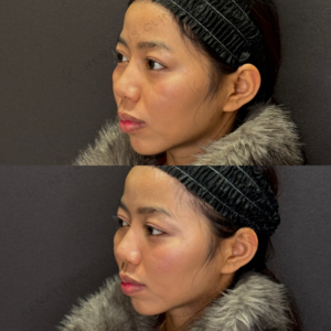 ゴルゴラインヒアルロン酸症例写真の症例写真