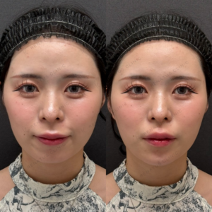 松村顎ヒアルロン酸人気症例