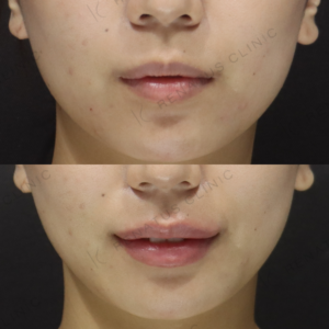 渡邊 莉子唇ヒアルロン酸人気症例