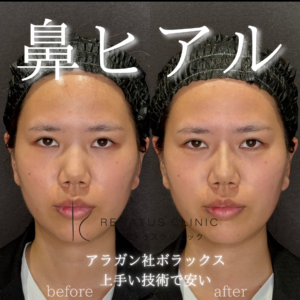 鼻ヒアルロン酸人気症例
