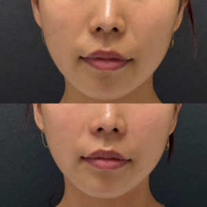 鼻翼基部ヒアルロン酸ボリューマ症例写真の症例写真