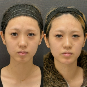 顎ヒアルロン酸症例写真の症例写真