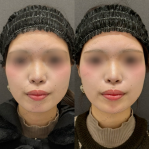 顎ヒアルロン酸症例写真の症例写真