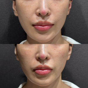 リフトアップヒアルロン酸ボリューマ症例写真の症例写真