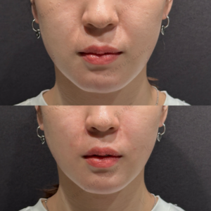 鼻翼基部ヒアルロン酸ボリューマボリフト症例写真の症例写真