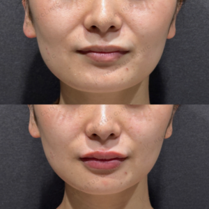 唇ヒアルロン酸ボルベラ症例写真の症例写真