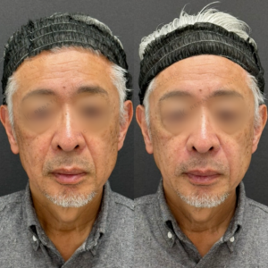 ほうれい線ヒアルロン酸症例写真の症例写真