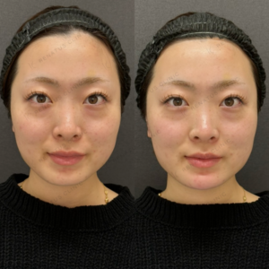 顎ヒアルロン酸ボラックス症例写真の症例写真