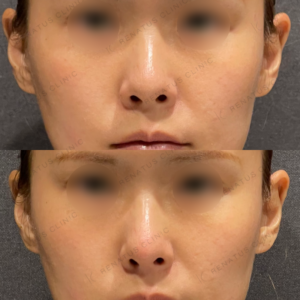 鼻ヒアルロン酸ボラックス症例写真の症例写真