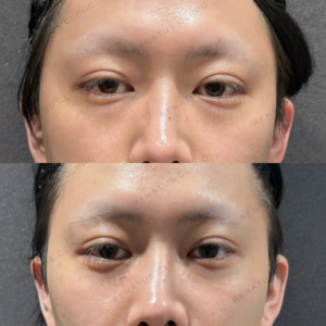 目の下のクマ取り症例写真の症例写真