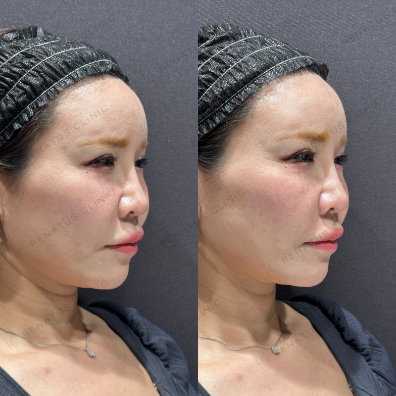 ゴルゴ鼻翼基部ヒアルロン酸ボリフト症例写真