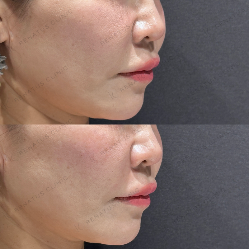 ゴルゴ鼻翼基部ヒアルロン酸ボリフト症例写真