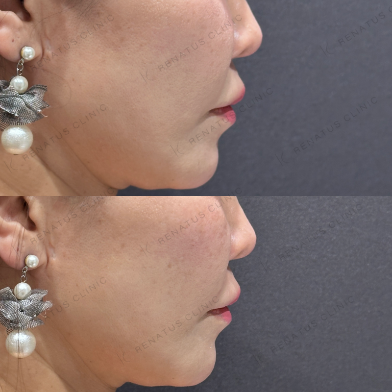 ゴルゴ鼻翼基部ヒアルロン酸ボリフト症例写真