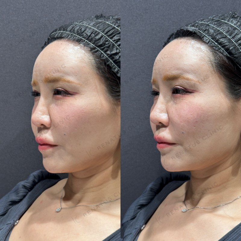 ゴルゴ鼻翼基部ヒアルロン酸ボリフト症例写真