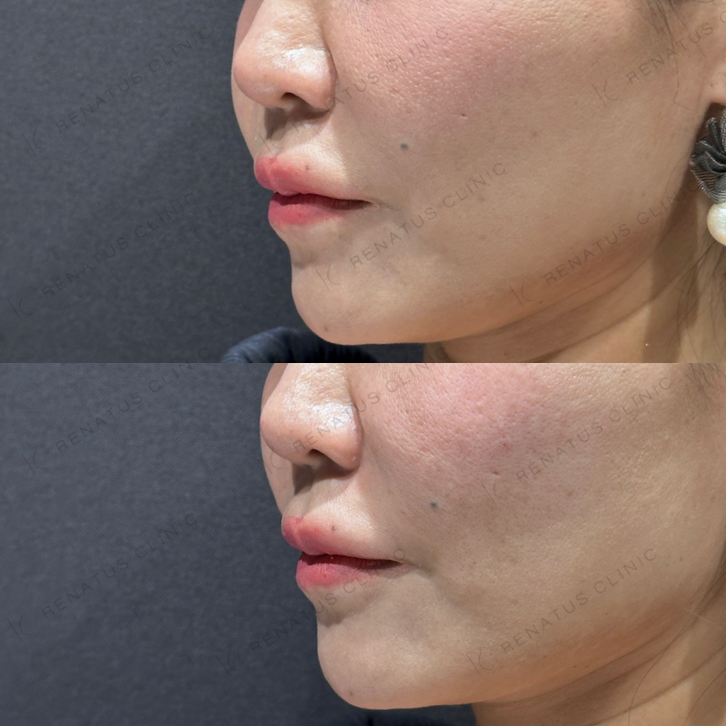 ゴルゴ鼻翼基部ヒアルロン酸ボリフト症例写真