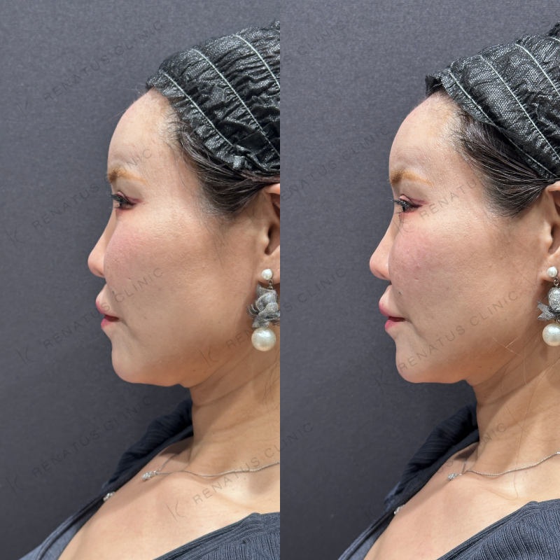 ゴルゴ鼻翼基部ヒアルロン酸ボリフト症例写真