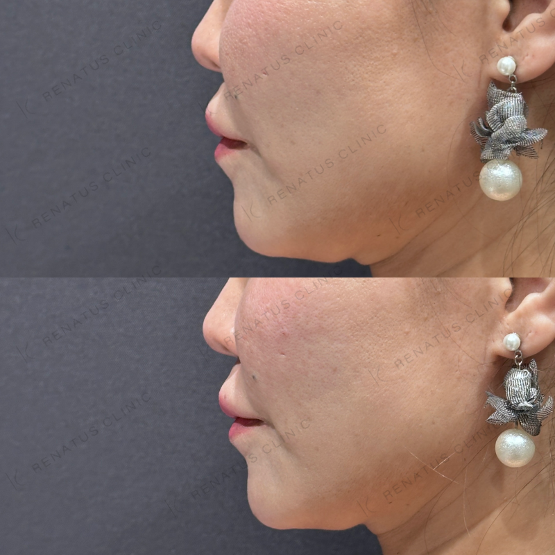 ゴルゴ鼻翼基部ヒアルロン酸ボリフト症例写真