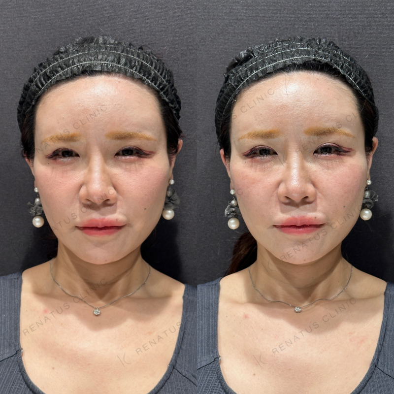 ゴルゴ鼻翼基部ヒアルロン酸ボリフト症例写真