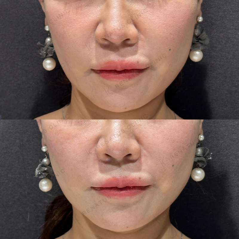 ゴルゴ鼻翼基部ヒアルロン酸ボリフト症例写真