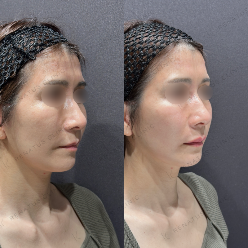 上唇ヒアルロン酸ボルベラ症例写真