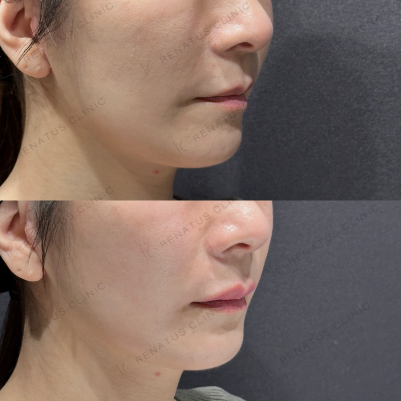 上唇ヒアルロン酸ボルベラ症例写真