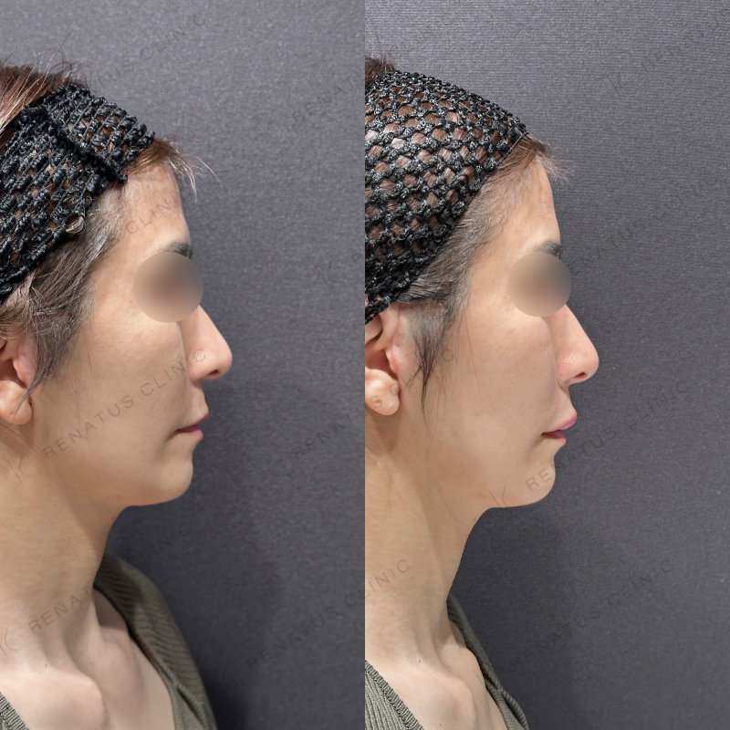 上唇ヒアルロン酸ボルベラ症例写真