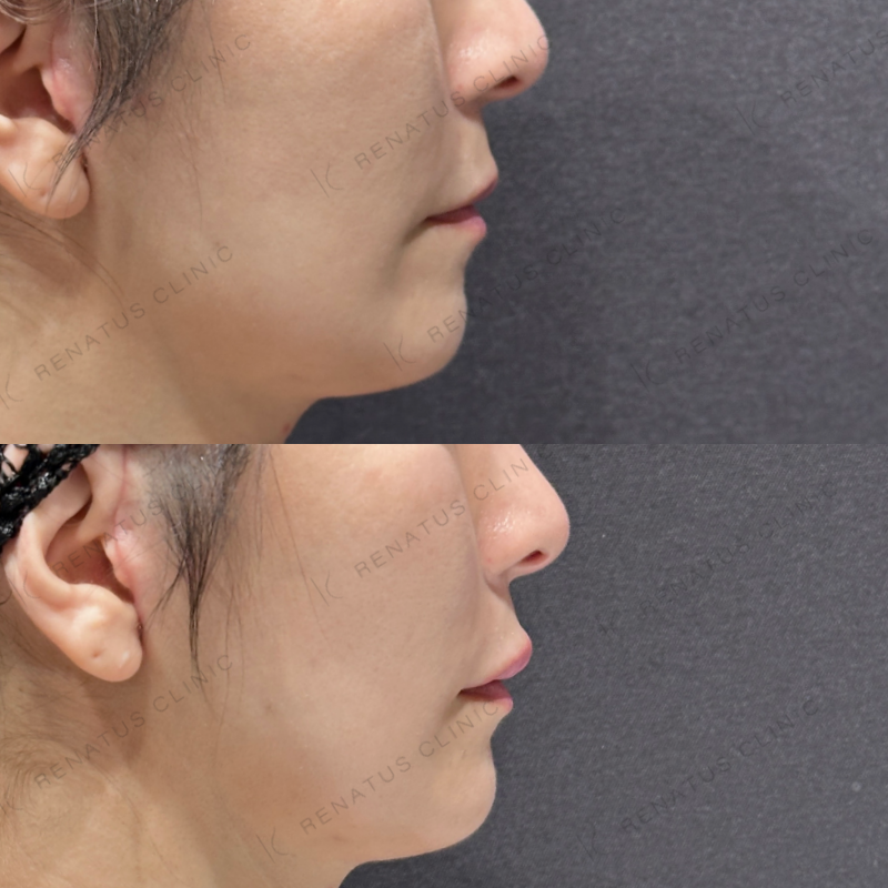 上唇ヒアルロン酸ボルベラ症例写真