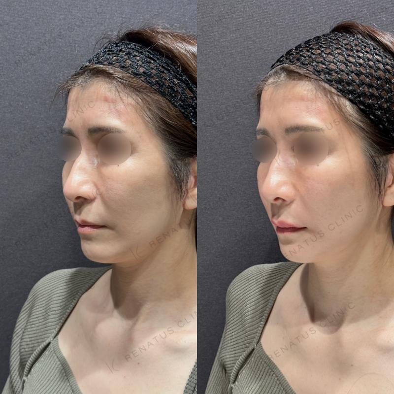 上唇ヒアルロン酸ボルベラ症例写真