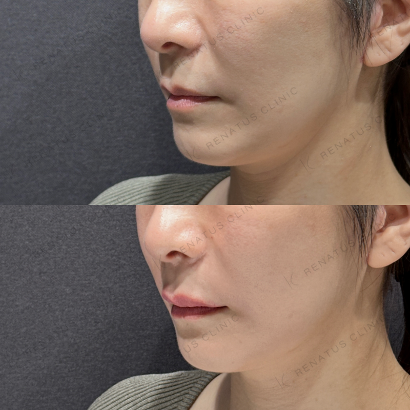 上唇ヒアルロン酸ボルベラ症例写真